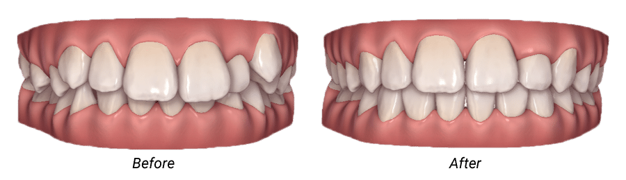 Before and after Great Valley Orthodontics in Malvern, PA