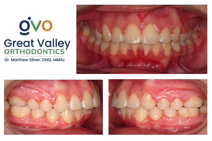 Before and after Great Valley Orthodontics in Malvern, PA