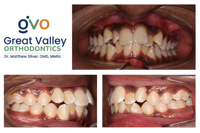 Before and after Great Valley Orthodontics in Malvern, PA
